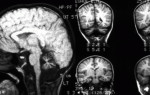 Подробно о гипоплазии мозжечка: причины, симптомы, диагностика, лечение, профилактика