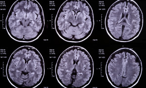 Абсцессы головного мозга: причины появления и лечение
