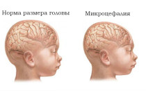 Микроцефалия головного мозга • причины, симптомы, лечение
