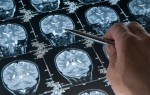 Симптомы, разновидности и лечение опухолей головного мозга