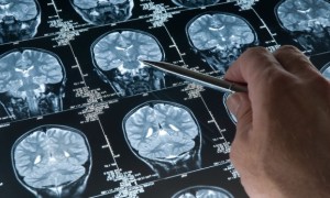 Симптомы, разновидности и лечение опухолей головного мозга
