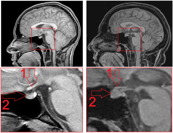 Аденома гипофиза головного мозга - лечение, операция по удалению опухоли (стоимость резекции аденомы гипофиза).