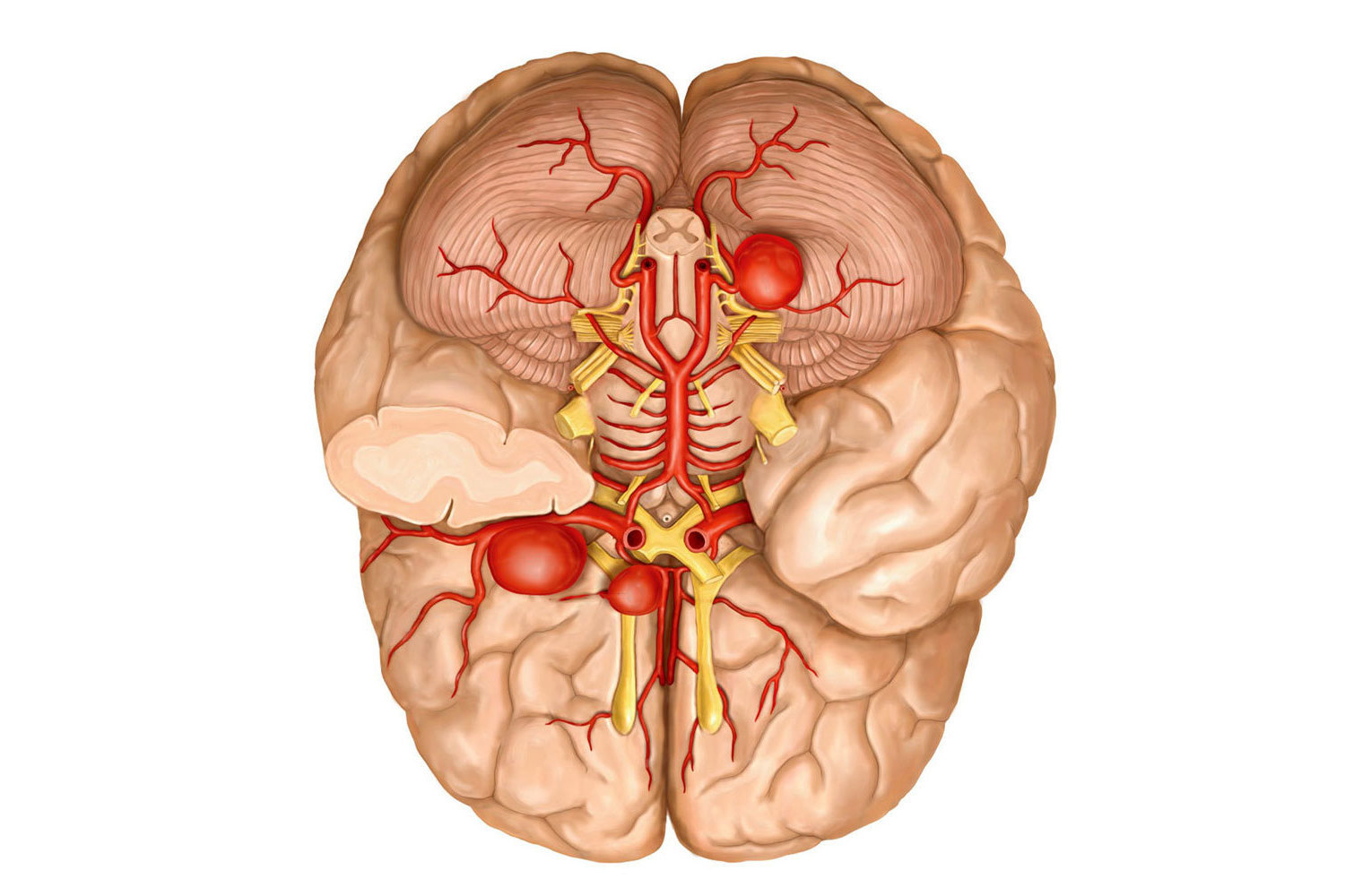 аневризма в мозъка