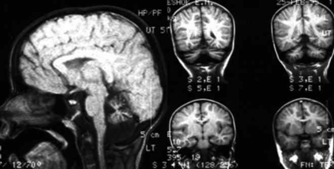 Что представляет собой гипоплазия мозжечка