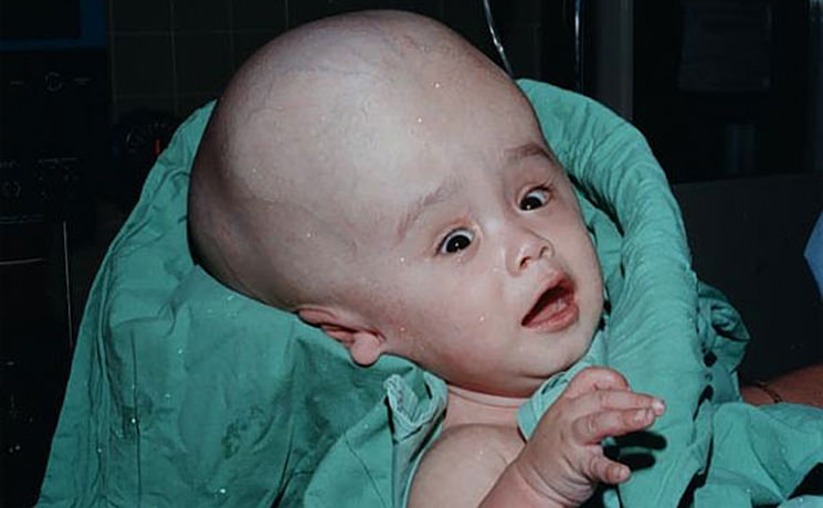 Гидроцефалия головного мозга у детей и новорожденных: признаки водянки и лечение