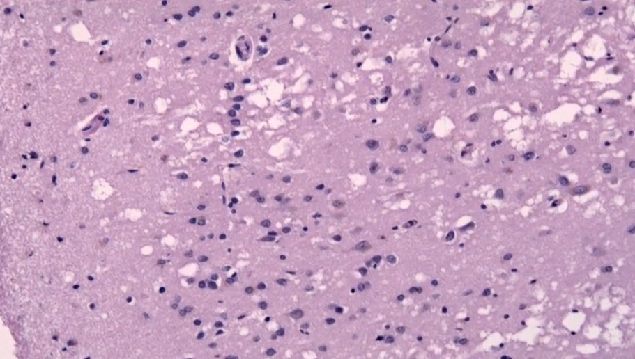 ткань головного мозга, пораженная прионной инфекцией